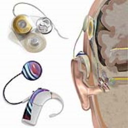 bionic ear transplant to increase hearing
