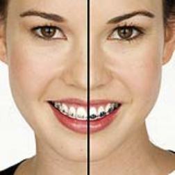 Braces which are made from a translucent ceramic material