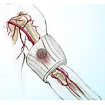 ultrasonic tourniquet that can stop life-threatening bleeding during combat