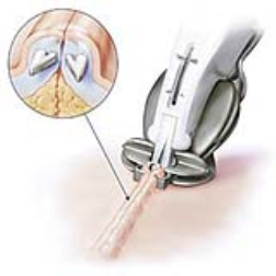 The staple-less skin stapler combines the cosmetic result of absorbable sutures with the rapid closure times of metal skin staplers