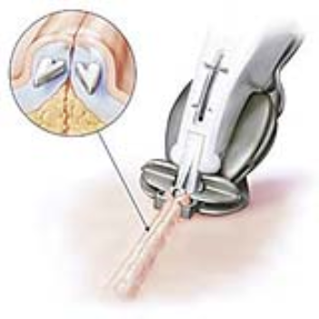 The staple-less skin stapler combines the cosmetic result of absorbable sutures with the rapid closure times of metal skin staplers