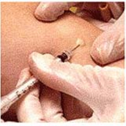 An intra-dermal application via the dendritic cells will give stronger cellular immunity