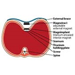 A magnet attached to the breastbone and one outside can help a sunken chest