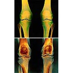 An electronic knee pad offers symptomatic relief from osteoarthritis