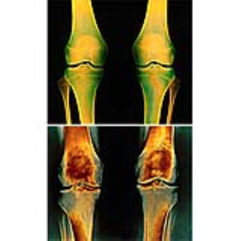 An electronic knee pad offers symptomatic relief from osteoarthritis