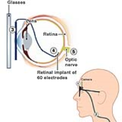 This implant device is mounted on your glasses and processes images to a receiver in the eye
