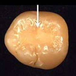 A calcium phosphate nanocomposite filling in a tooth release decay-fighting agents