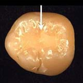 A calcium phosphate nanocomposite filling in a tooth release decay-fighting agents