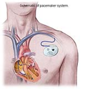 A pacemaker which is powered by the patients heart